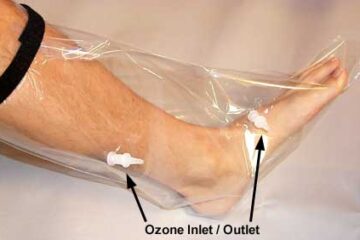 Terapie locala cu sac cu ozon
